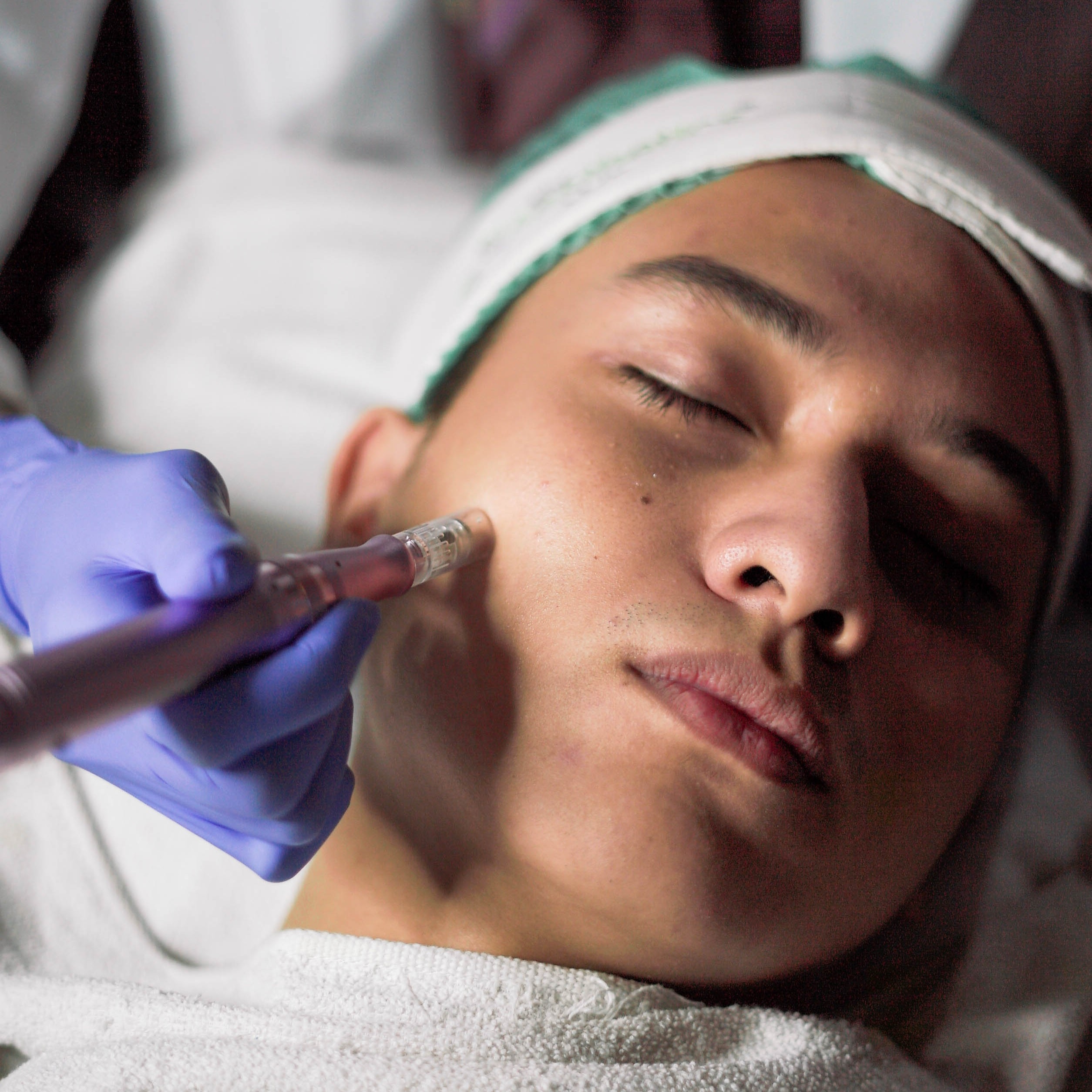 Microneedling: Manfaat, Risiko, dan Hasil yang Realistis untuk Kulit Kamu